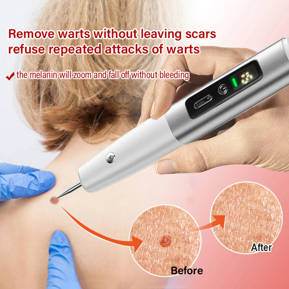 Dark Spot Mole Wart Remover Pen – Your At-Home Skin Solution